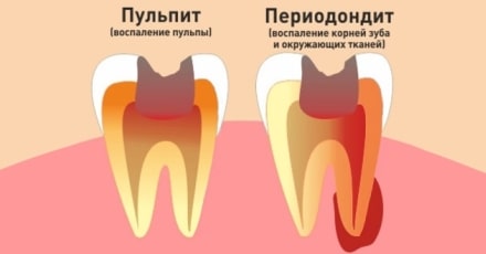 Лечение пульпита, периодонтита